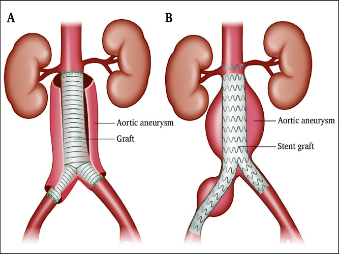 Aortic Anuerysm Treatment in Hyderabad